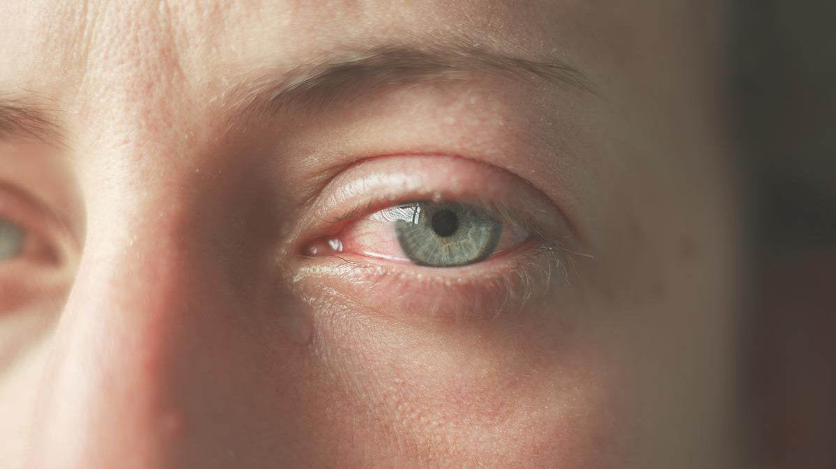 Cheratite: non confonderla con una semplice infiammazione dell'occhio