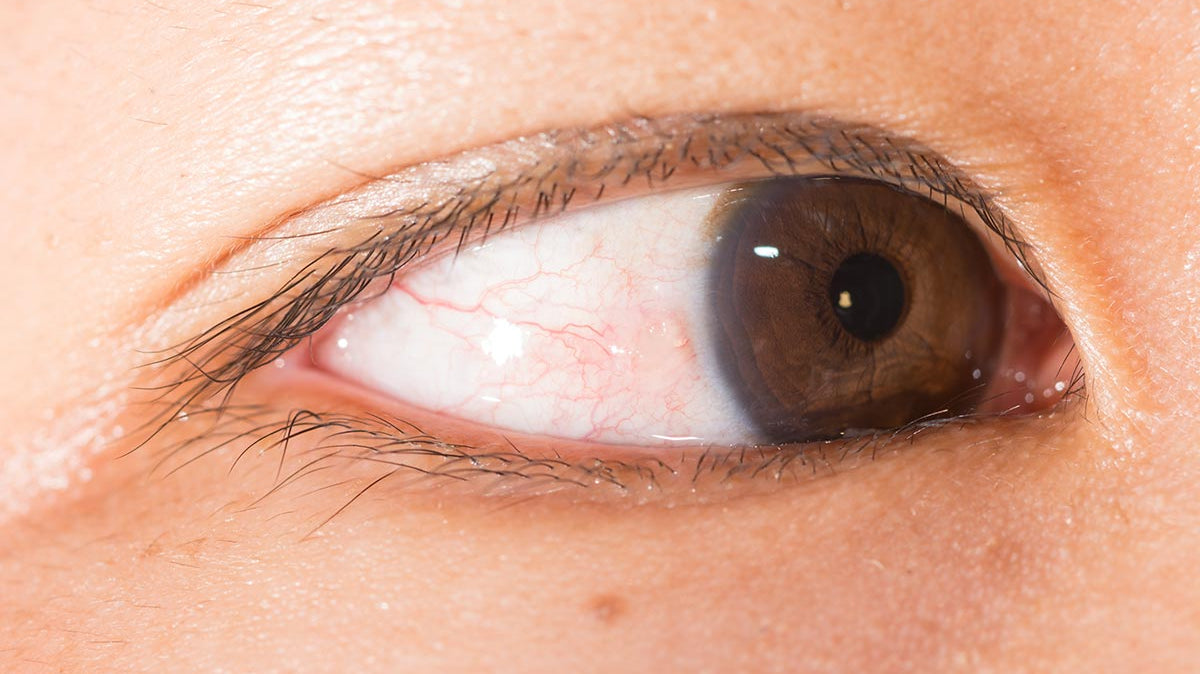 Ti sei accorto di avere una macchia gialla/bianca nell'occhio?