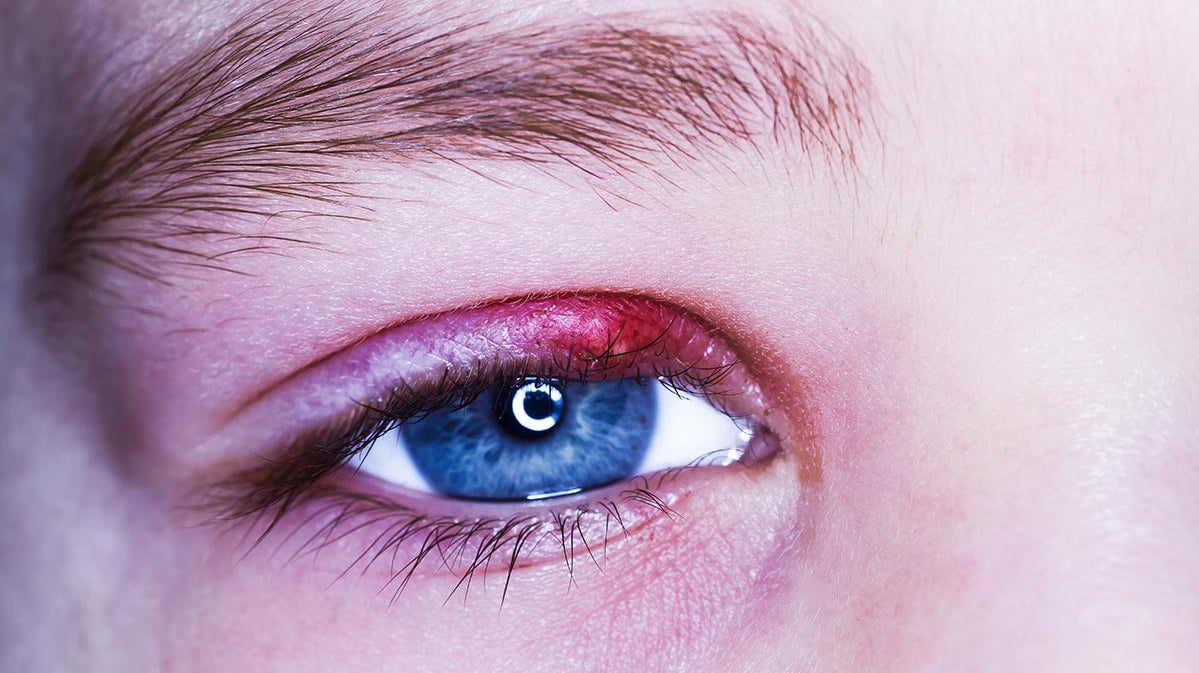 Orzaiolo: perché viene questa ciste nell'occhio?