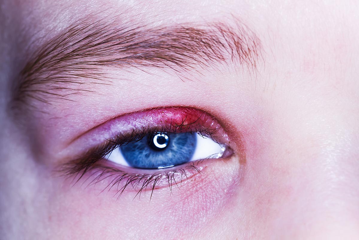 Orzaiolo: perché viene questa ciste nell'occhio?