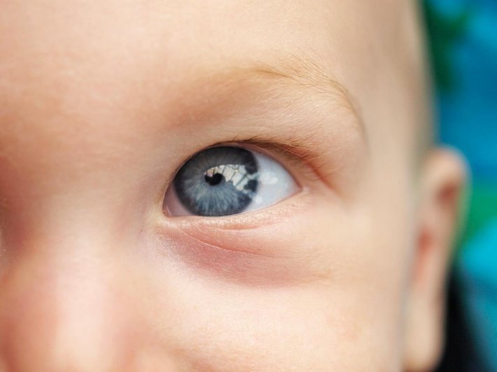 malattie dell'occhio nei bambini